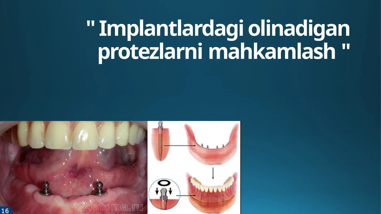 " Implantlardagi olinadigan protezlarni mahkamlash "